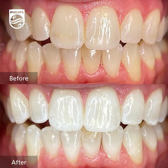 before and after photos for teeth whitening in bondi
