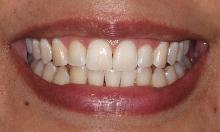 close up of smile after braces