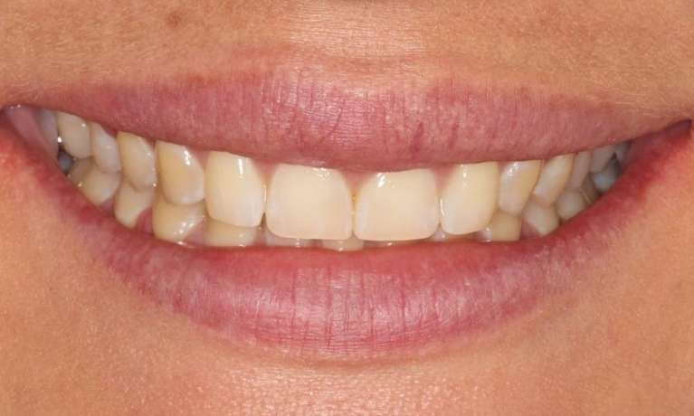 patient's smile after orthodontics