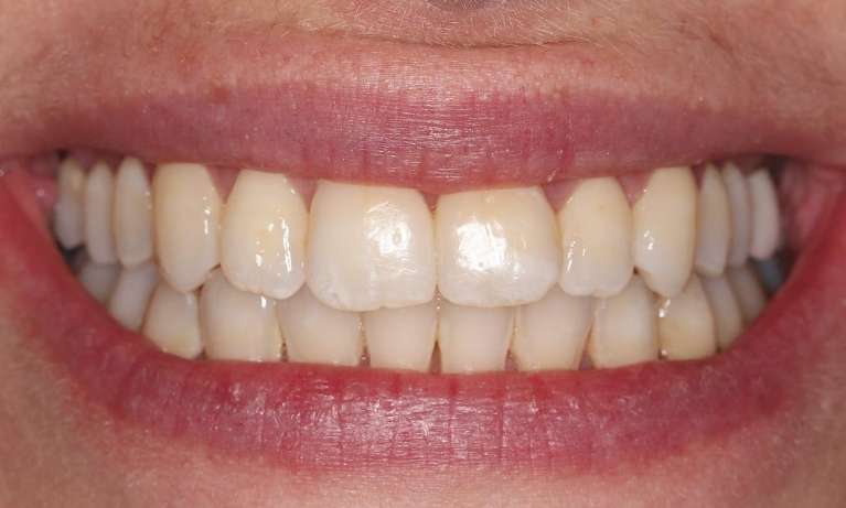 smile after straightening front tooth