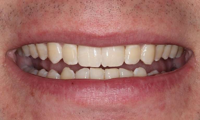 close up of smile after braces