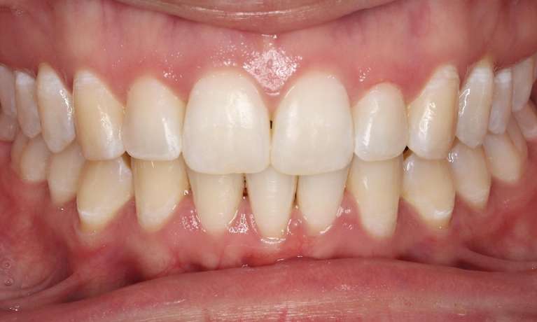close up of smile after braces