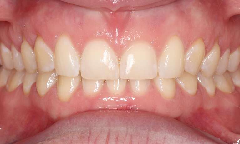 smile of patient after orthodontics in bondi