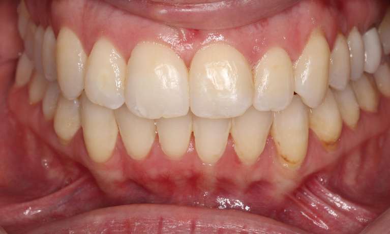 smile after straightening teeth with orthodontics in bondi
