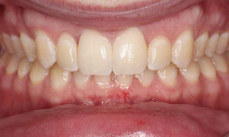 close up of smile after braces