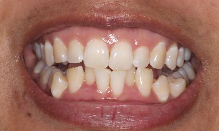 close up of smile with crooked bottom teeth before braces