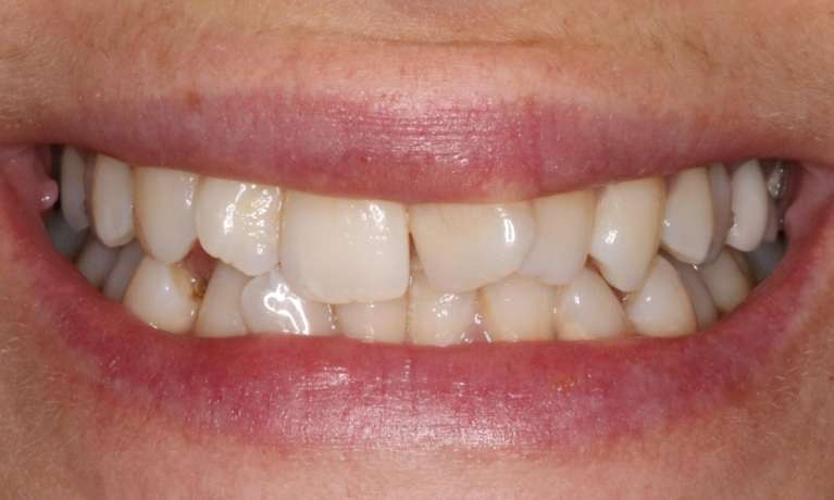 crooked front tooth before ortho