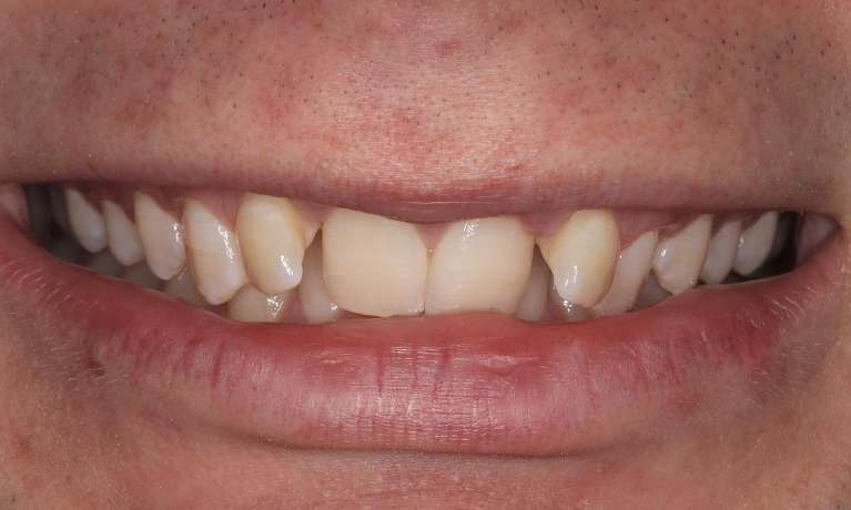 close up of smile before braces