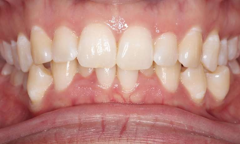 close up of smile with crooked bottom teeth before braces