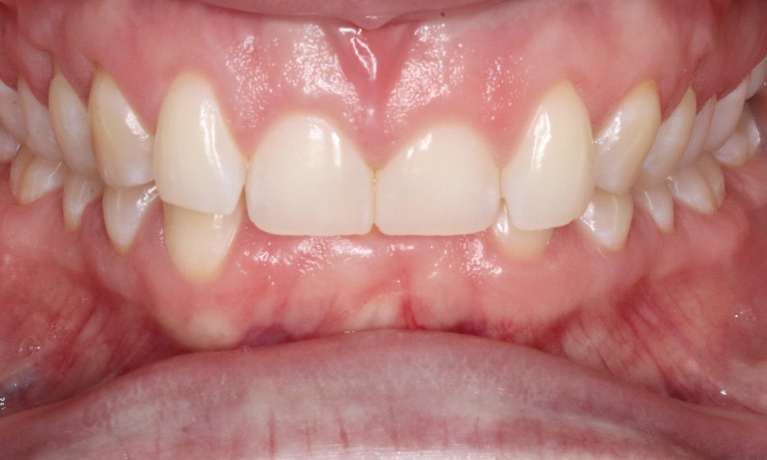 smile before orthodontics in bondi