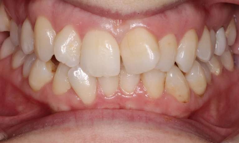 crooked front teeth before ortho