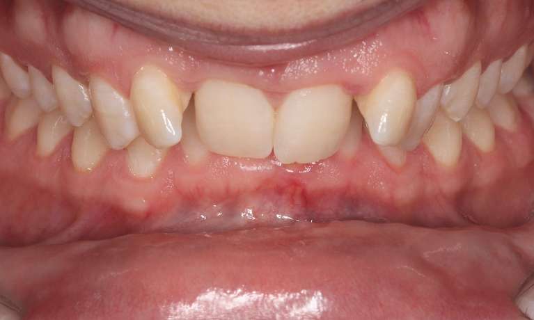 close up of smile before braces